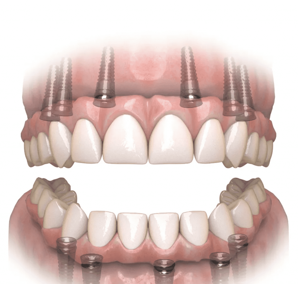 All on X Implants in Newton & Boston | Newton Dental Associates